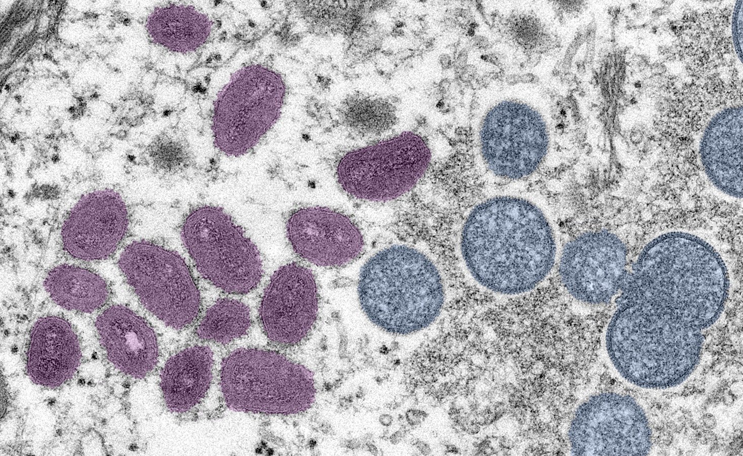 is digitally-colorized electron microscopic image depicts monkeypox virus particles, obtained from a clinical sample associated with the 2003 prairie dog outbreak.